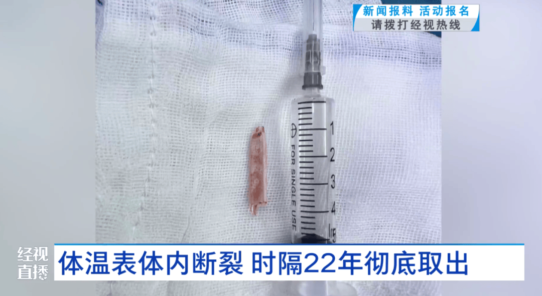 体温表在体内断裂<strong></p>
<p>兔币</strong>，女子时隔22年彻底取出！医生：庆幸水银不在里面
